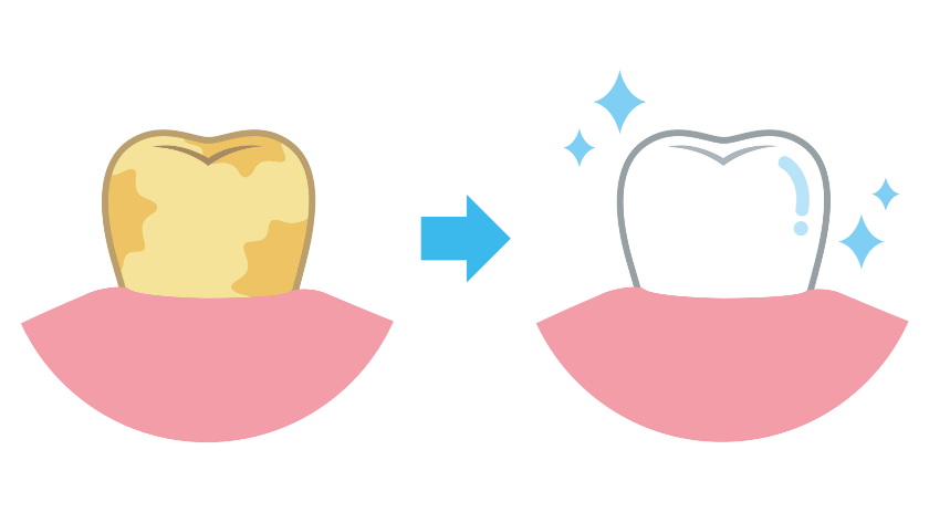 効果を実感しやすいホワイトニング